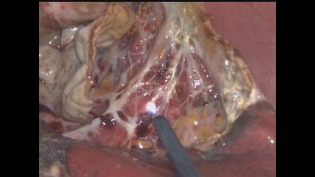 Лапароскопическая Резекция кисты селезенки смотреть онлайн