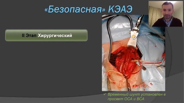 Каротидная эндартерэктомия: безопасное вмешательство с позиции ангиохирурга смотреть онлайн