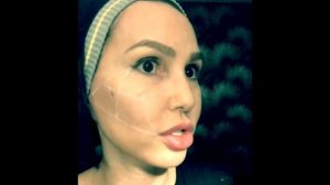 КОНТУРНАЯ ПЛАСТИКА СКУЛ ФИЛЛЕРОМ, ТРЕУГОЛЬНИК МАРИИ ЛАНДАУ