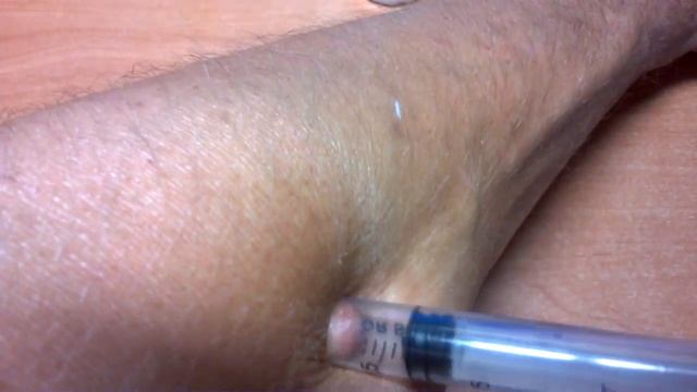 Как удалить клеща у человека смотреть онлайн