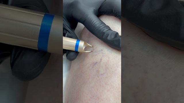 Лазерное удаление купероза (сосудистой сетки) в Sokolov Laser смотреть онлайн