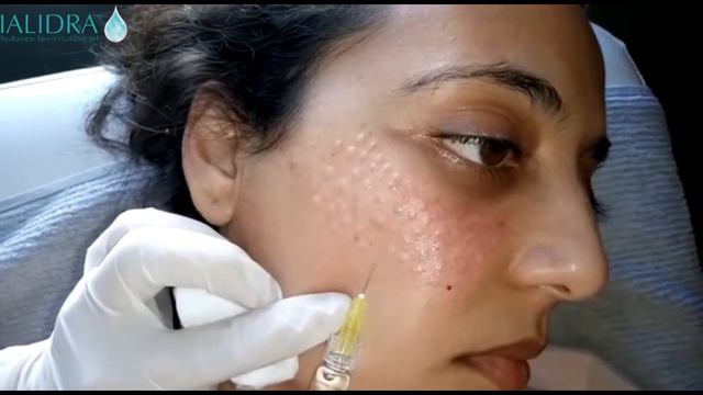 IALIDRA. Technique d injection en nappage. Dr Kamelia Jawhari Casablanca Maroc смотреть онлайн