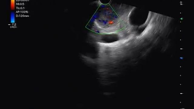Every lymph node in mediastinum is not tuberculosis. "Endosonography Ultrasound" by Dr. Sanjay Garg смотреть онлайн