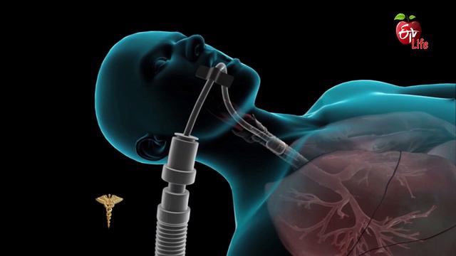 Dr. ETV | Respiratory disease | 16th March 2018 | డాక్టర్ ఈటివీ смотреть онлайн