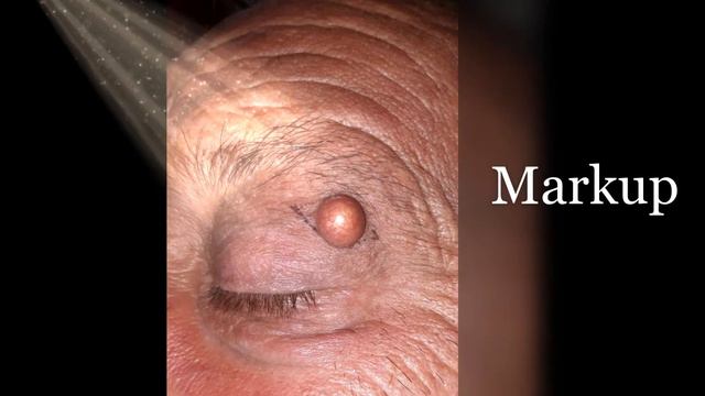 Хірургічне видалення епідермальної кісти верхньої повіки. Surgical removal of an epidermal cyst. смотреть онлайн