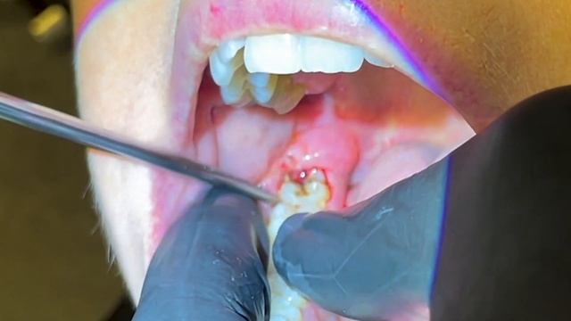 Not All Wisdom Tooth Surgery Is Bad (Partially Erupted Lower Third Molar Removal) смотреть онлайн