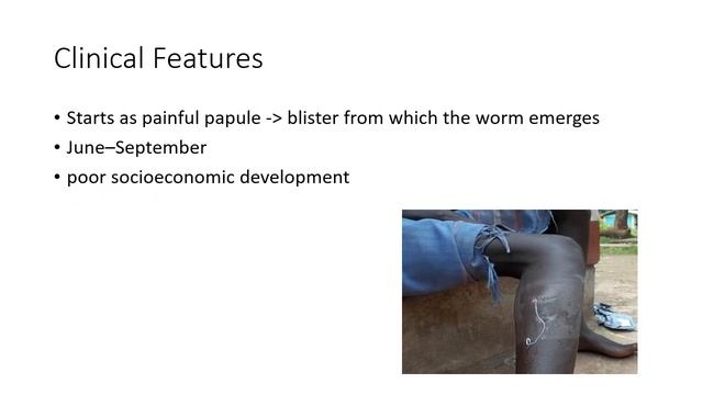Dracunculus medinensis - Parasitology смотреть онлайн