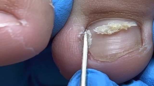 Ingrown toenails make toes swell and turn yellow【Xue Yidao Pedicure】 смотреть онлайн