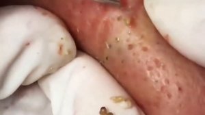 Удаление акне!Прыщи выдавливание!Выдавливание прыщей