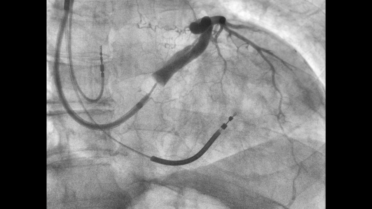 Contrast study coronary sinus смотреть онлайн