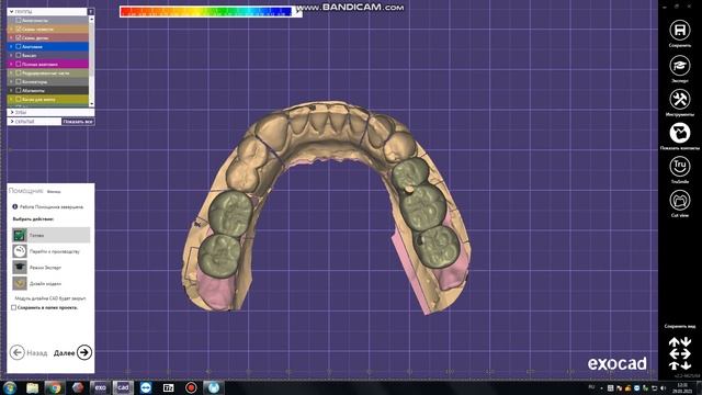 Винтовая фиксация циркон+коронки циркон на абатментах .Программа EXOCAD смотреть онлайн