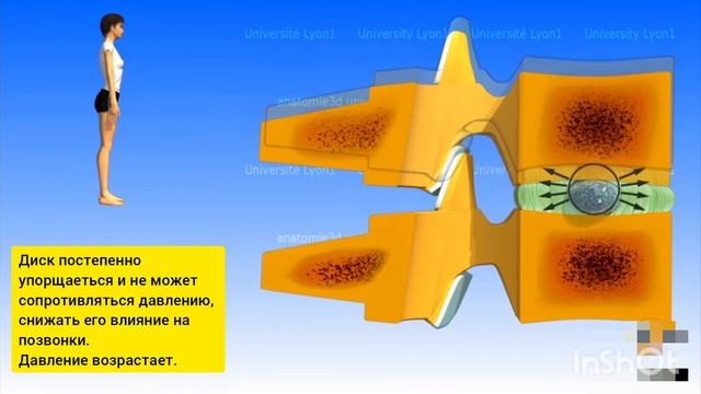 МЕЖПОЗВОНКОВЫЕ ДИСКИ. 3D обзор. 1 часть. смотреть онлайн