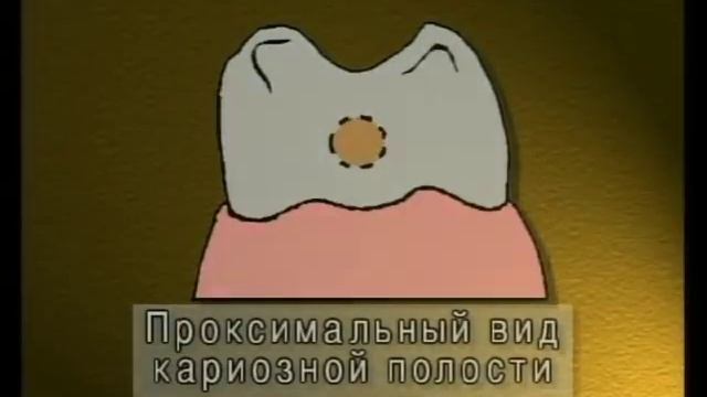 11 Особенности препарирования кариозных полостей ll класса по Блэку смотреть онлайн