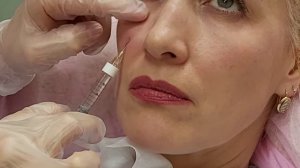 Заполнение носослезной борозды с применением канюли.