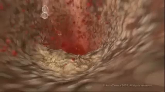 MEDICAL - How cholesterol clogs your arteries (atherosclerosis) смотреть онлайн