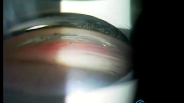 Гониоскопия с четырехзеркальной линзой смотреть онлайн
