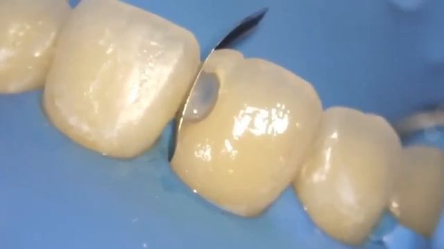 Class 3 composite restoration смотреть онлайн