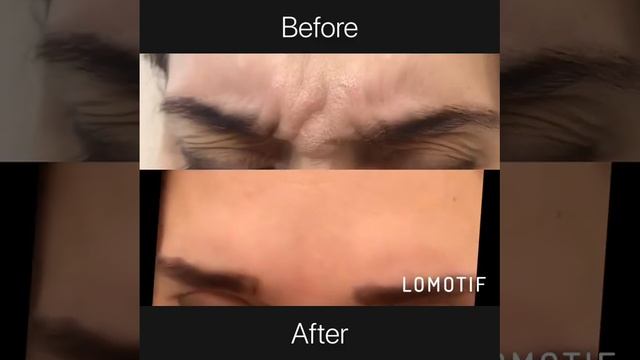 Ботулинотерапия смотреть онлайн