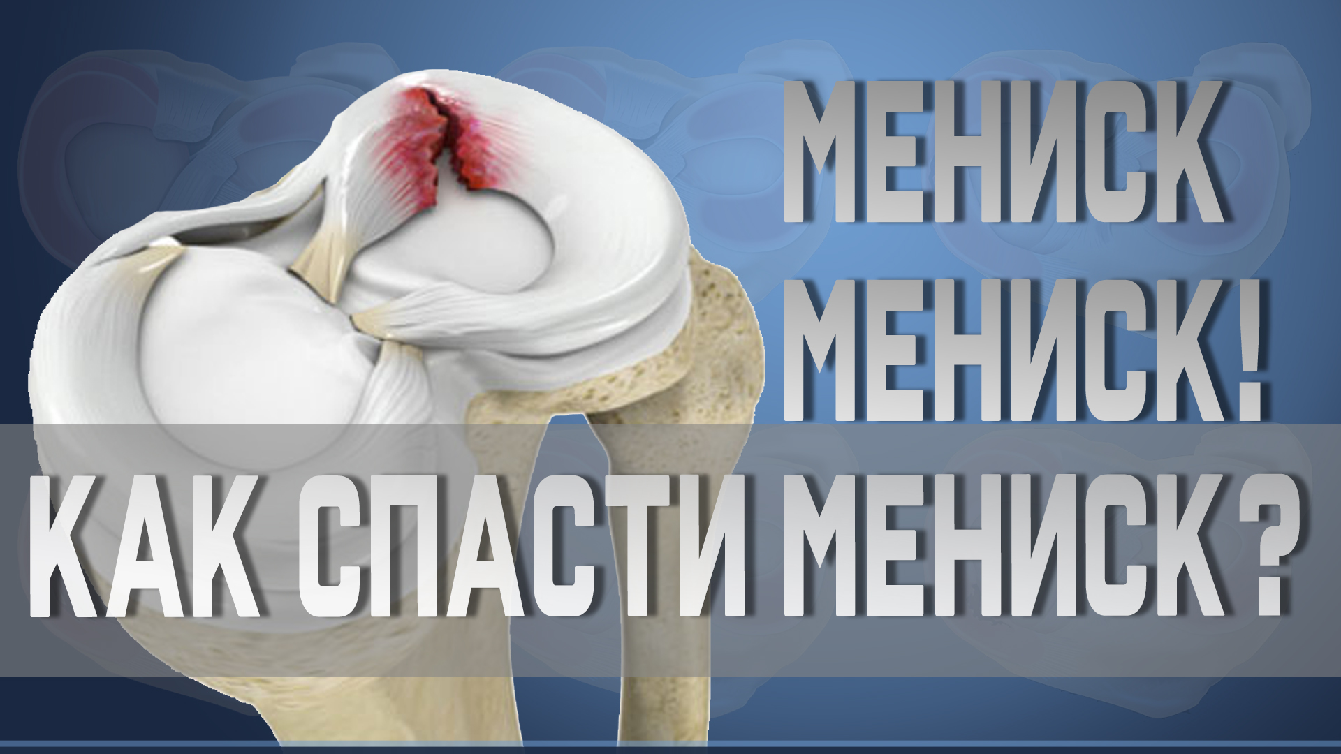 Разрывы, травмы, повреждения мениска. Резать или лечить?