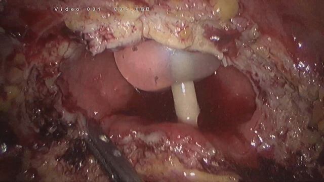 Лапароскопическая резекция сигмовидной кишки с резекцией тонкой кишки, мочевого пузыря (Видео 6) смотреть онлайн