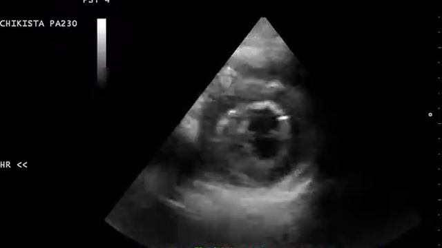 fibrous band in left ventricle смотреть онлайн