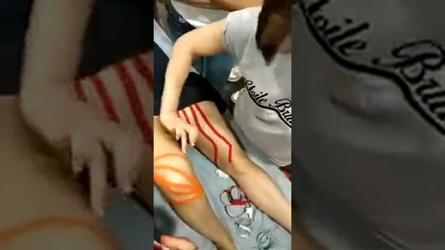 ТЕЙПИРОВАНИЕ КОЛЕНА