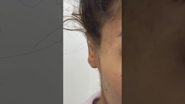 Отопластика (избавление от лопоухости) смотреть онлайн