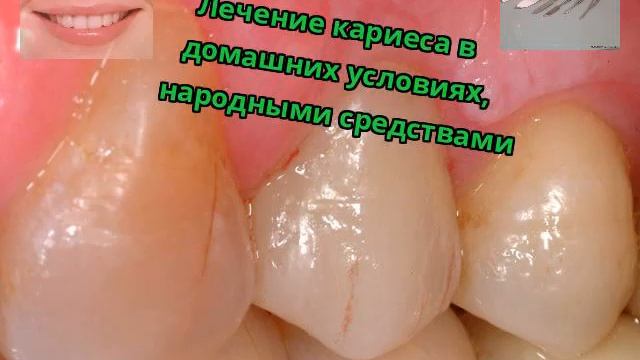 Лечение кариеса в домашних условиях, народными средствами смотреть онлайн