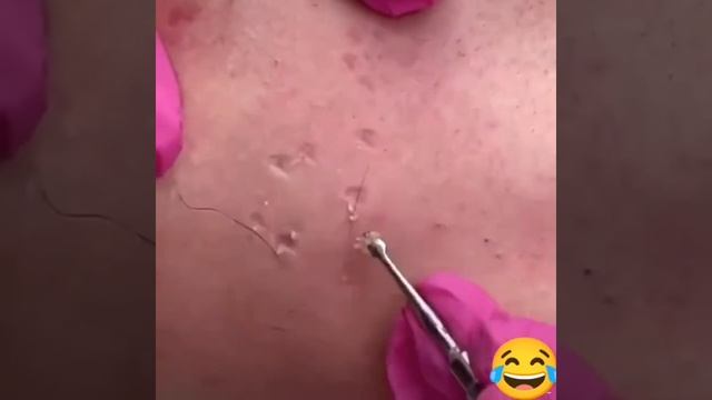 Самое залипательное видео давить прыщи Черные точки смотреть онлайн