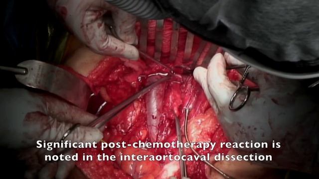 Core Videos (2020): Open Retroperitoneal Lymph Node Dissection смотреть онлайн