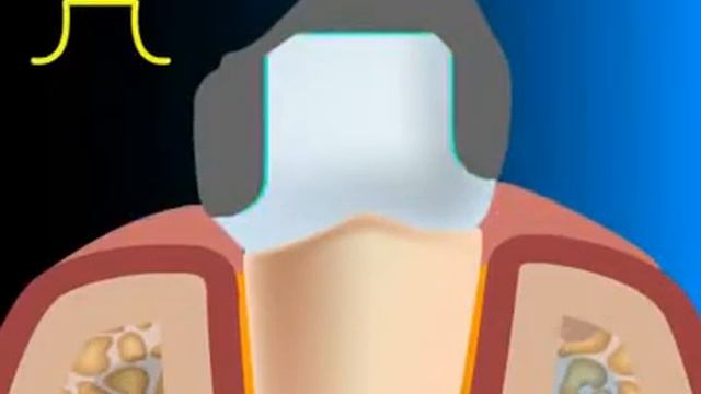 Что такое зубные коронки смотреть онлайн