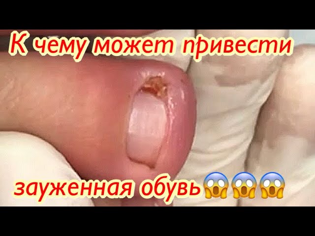 К чему может привести зауженная обувь смотреть онлайн