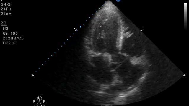 Эхо-КС. диссекция корня и восходящего отдела аорты смотреть онлайн
