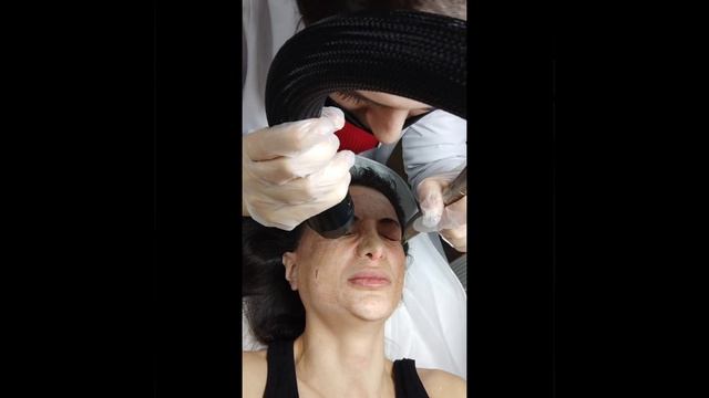 08.03.2023 Fotona laser . Лазерная шлифовка на аппарате фотона. #fotonalaser #laserresurfacing смотреть онлайн