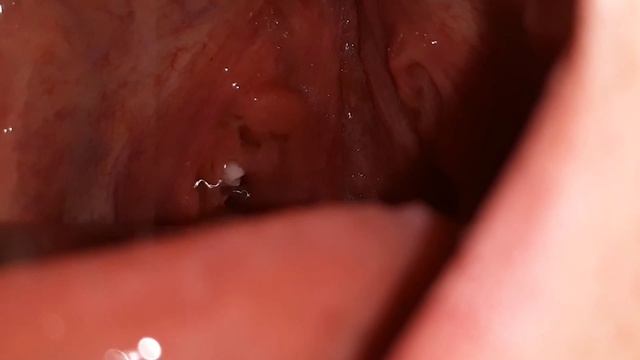 Tonsil Stone Removal With The Irrigator - Ep. 2 - Cutting The Cheese смотреть онлайн