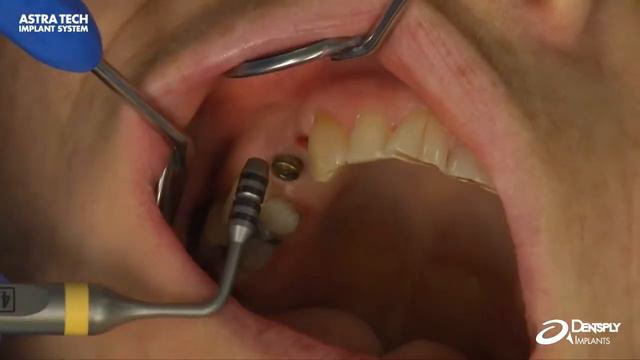 Astra Tech Implant System EV - Soft tissue measurement using Abutment Depth Gauge EV смотреть онлайн