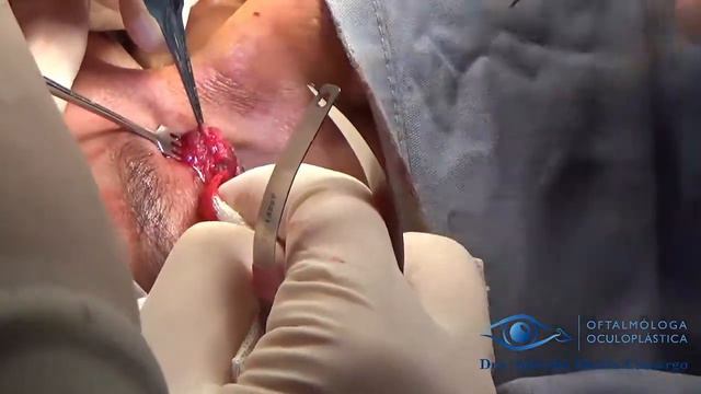 ORBITOTOMIA ANTERIOR / VIA SURCO PALPEBRAL смотреть онлайн