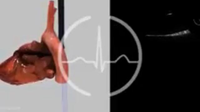 Сканирование нисходящей аорты по длинной оси сердца