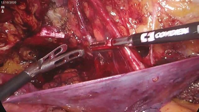 Лапароскопическая герниопластика (TAPP) при рецидивной паховой грыже / TAPP Recurrent Hernia Repair