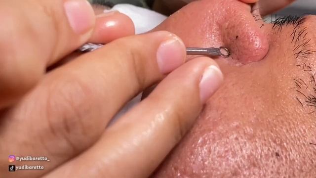 MENGHILANGKAN BOPENG PADA WAJAH DI JAVA MEDICA смотреть онлайн