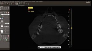 Программа NNTViewer iRYS Viewer  Компьютерная томограмма планирование имплантация зубов 3Д