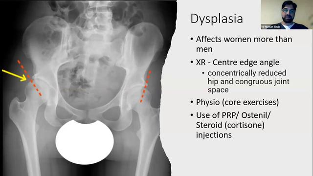 Hip Pain and When To Refer | Mr Numan Shah, Consultant Orthopaedic and Trauma Surgeon | Scan.com смотреть онлайн