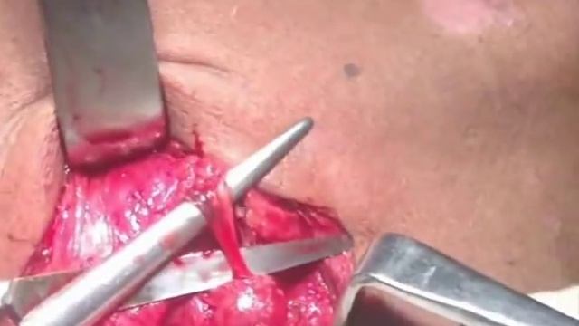 submandibular approach смотреть онлайн