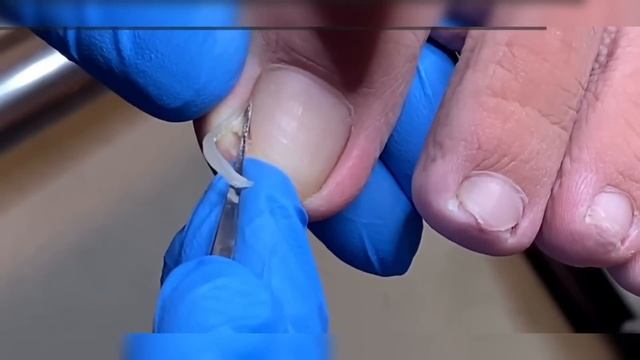 Paronychia Treatment, The Position Of The Ingrown Nail Is Very Deep! #pedicure #correction