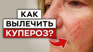Это заболевание ИСПОРТИТ ВАШЕ ЛИЦО! / Что такое купероз?