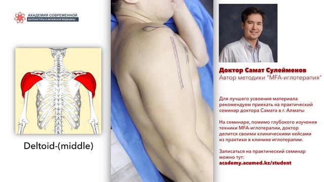 Сухая игла. Deltoid Middle . ДЕЛЬТОВИДНАЯ МЫШЦА. Безопасная постановка иглы.