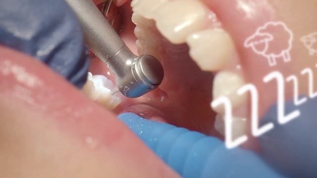 Mikroturbine TK-94 L für die Kinderzahnheilkunde смотреть онлайн