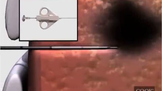 Quick Core Biopsy Needles Device Animation смотреть онлайн