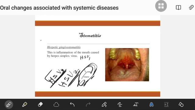 GIT - (Oral changes with systemic disease) смотреть онлайн