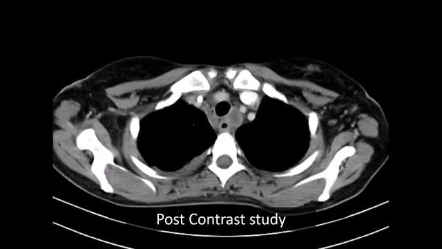 CT guided Hilar Node Biopsy смотреть онлайн